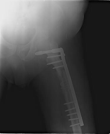 Sample image from FracAtlas