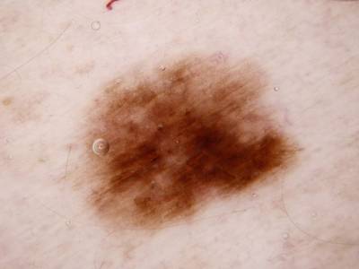 Sample image from Skin Cancer: HAM10000