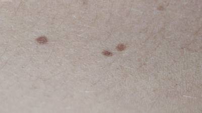 Sample image from Accurate Nevus Shapes