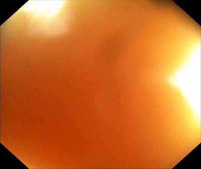 Sample image from PolypGen