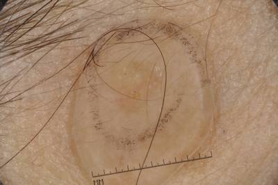 Sample image from ISIC 2017: Part 1 - Lesion Segmentation