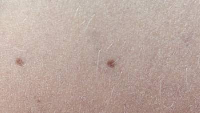 Sample image from Accurate Nevus Shapes