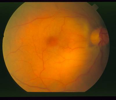 Sample image from STARE