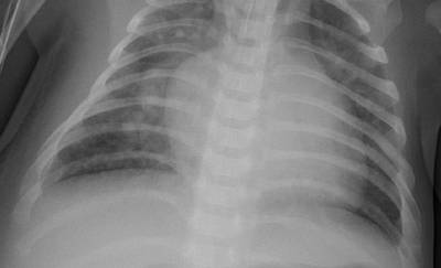 Sample image from ZhangLabData: Chest X-Ray