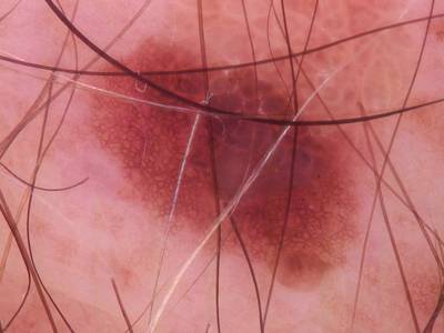 Sample image from Skin Cancer: HAM10000