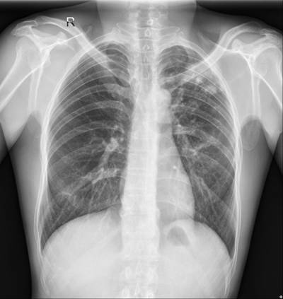 Sample image from Chest Xray Masks and Labels
