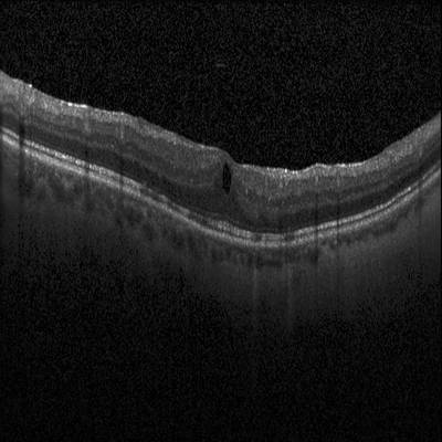 Sample image from Intraretinal Cystoid Fluid