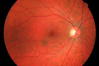 Sample image from High Resolution Fundus