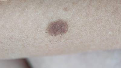 Sample image from Accurate Nevus Shapes