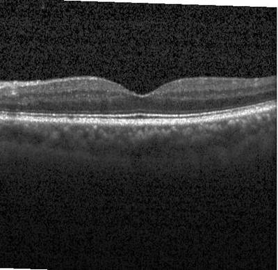 Sample image from ZhangLabData: OCT