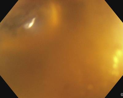Sample image from PolypGen
