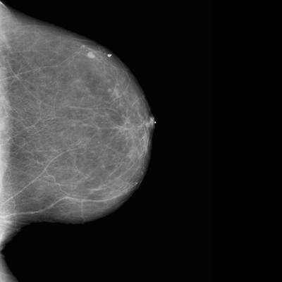 Sample image from CBIS-DDSM