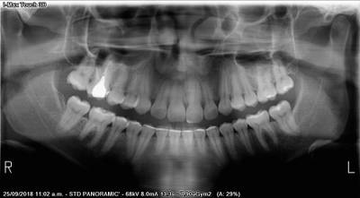 Sample image from Teeth Segmentation on Dental X-ray Images