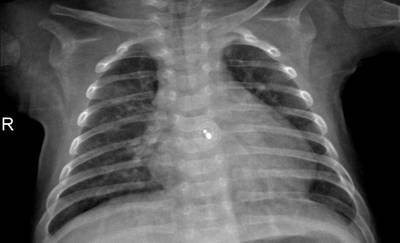Sample image from ZhangLabData: Chest X-Ray