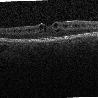 Sample image from Intraretinal Cystoid Fluid