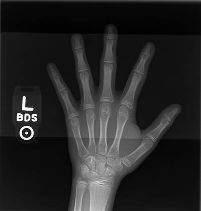 Sample image from RSNA Bone Age 2017