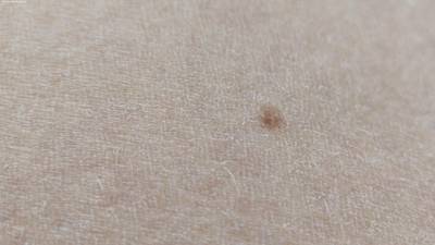 Sample image from Accurate Nevus Shapes