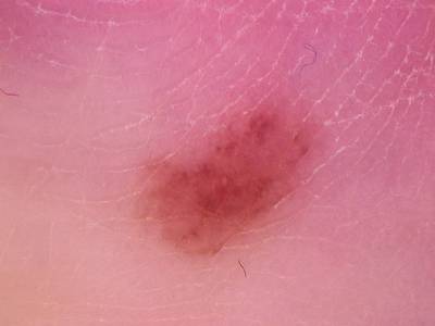 Sample image from Skin Cancer: HAM10000