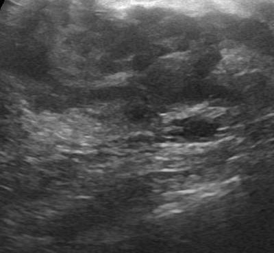 Sample image from Breast Ultrasound Images