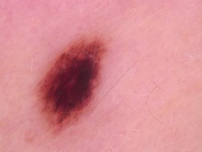 Sample image from Skin Cancer: HAM10000