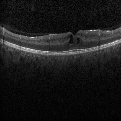 Sample image from Intraretinal Cystoid Fluid