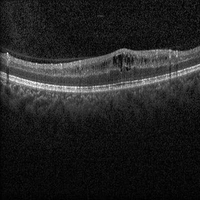 Sample image from Intraretinal Cystoid Fluid