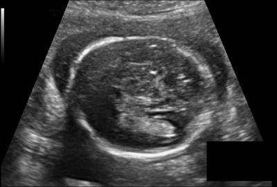 Sample image from Fetal Head UltraSound