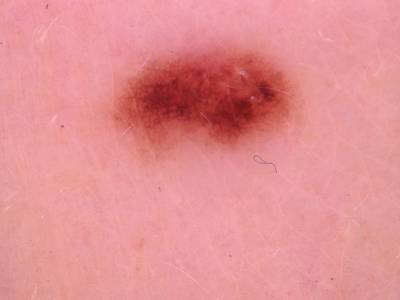 Sample image from Skin Cancer: HAM10000