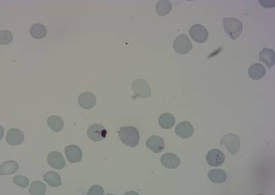Sample image from P. Vivax (Malaria) Infected Human Blood Smears