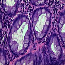 Sample image from EBHI-Seg