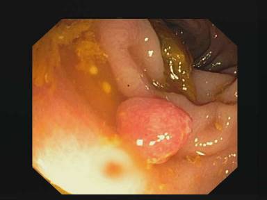 Sample image from CVC-ClinicDB
