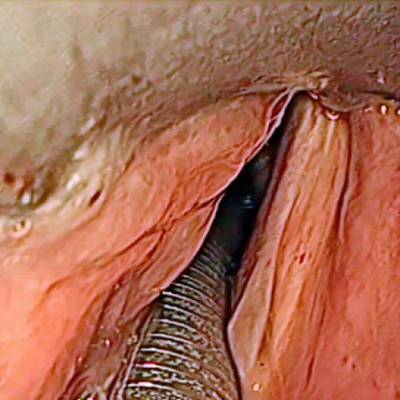 Sample image from Laryngeal Endoscopic