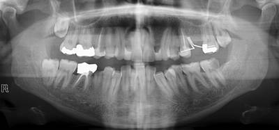 Sample image from Panoramic Dental X-rays