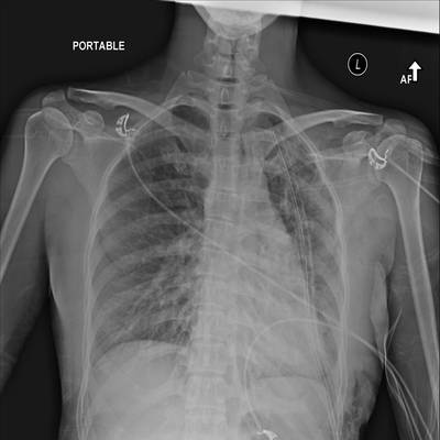 Sample image from SIIM-ACR Pneumothorax Segmentation 2019