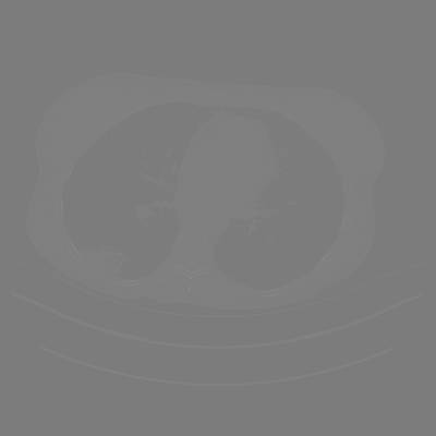 Sample image from DeepLesion
