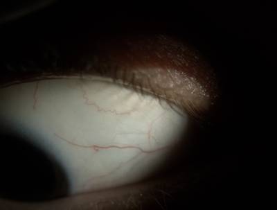Sample image from Eyes Microcirculation