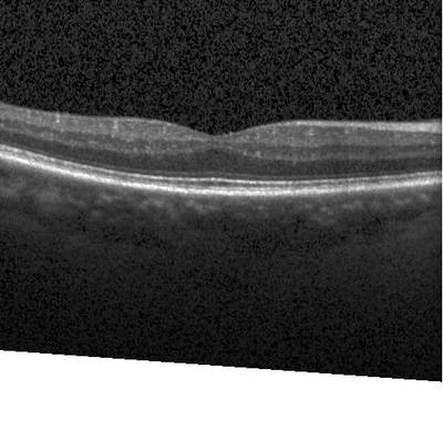 Sample image from ZhangLabData: OCT
