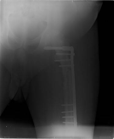 Sample image from FracAtlas
