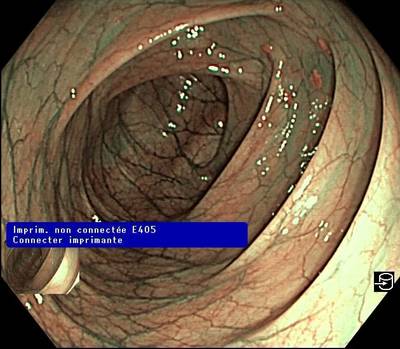 Sample image from PolypGen