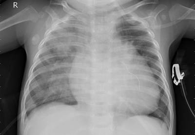 Sample image from ZhangLabData: Chest X-Ray