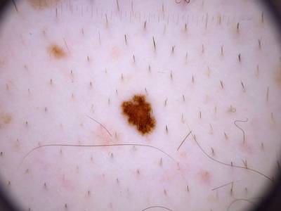 Sample image from Skin Cancer: HAM10000