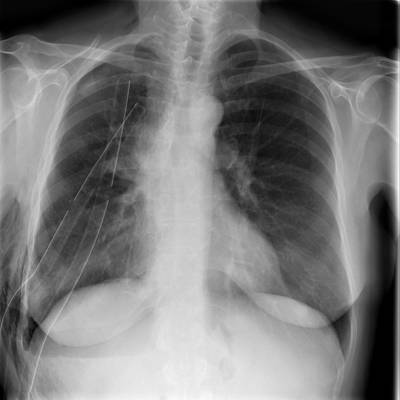 Sample image from SIIM-ACR Pneumothorax Segmentation 2019