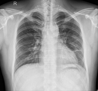 Sample image from Chest Xray Masks and Labels