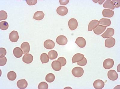Sample image from Plasmodium Falciparum from Images of Giemsa for Malaria Detection