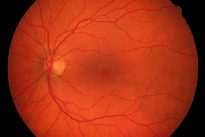 Sample image from High Resolution Fundus