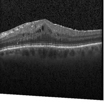 Sample image from Intraretinal Cystoid Fluid