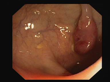 Sample image from CVC-ClinicDB