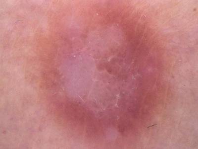 Sample image from Skin Cancer: HAM10000