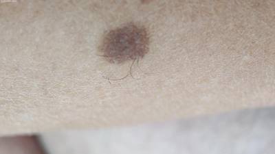 Sample image from Accurate Nevus Shapes
