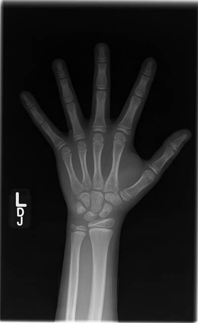 Sample image from RSNA Bone Age 2017